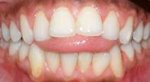 Tongue Thrusts Raise Havoc While Kids Are Growing