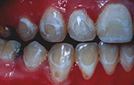 During Orthodontic Treatment… Is Fluoride Friend Or Foe?