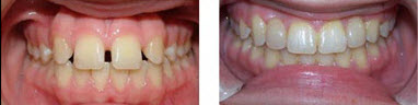 You Can’t Rush Mother Nature When Moving Teeth