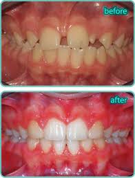 Missing Teeth – Is This Space Taken?