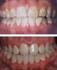 Decalcification – Common Causes of White Spots After Wearing Braces