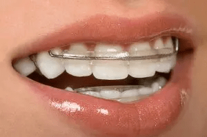 Retainers – An Investment in the Future of Your Smile